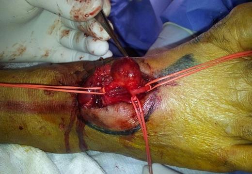 Intra-operative Image: Saccular aneurysm of the right dorsalis pedis artery