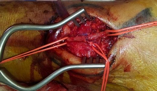 Intra-operative Image: Post resection of the aneurysm and reconstruction by end-to-end anastomosis