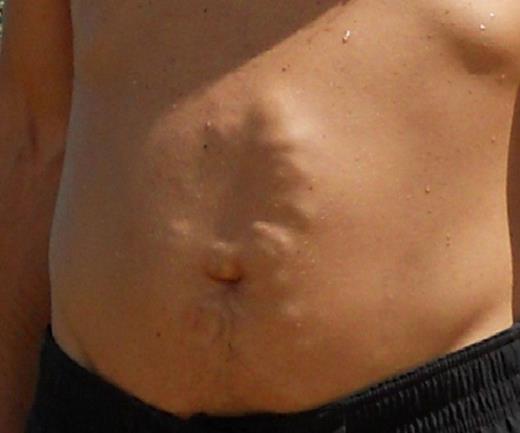 Preoperative abdominal varices