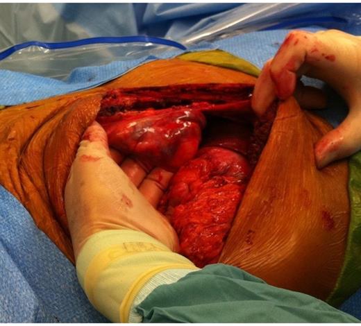 Abdominal wall varices