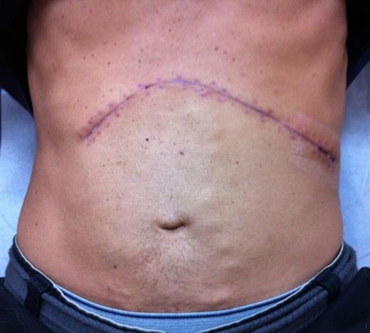 Healing well at four post-operative weeks