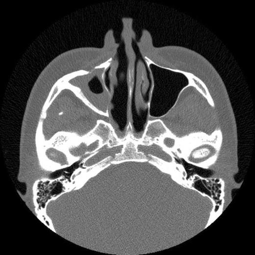 CT scan showing fracture of the anterolateral wall of the right maxillary sinus and absent upper medial wall