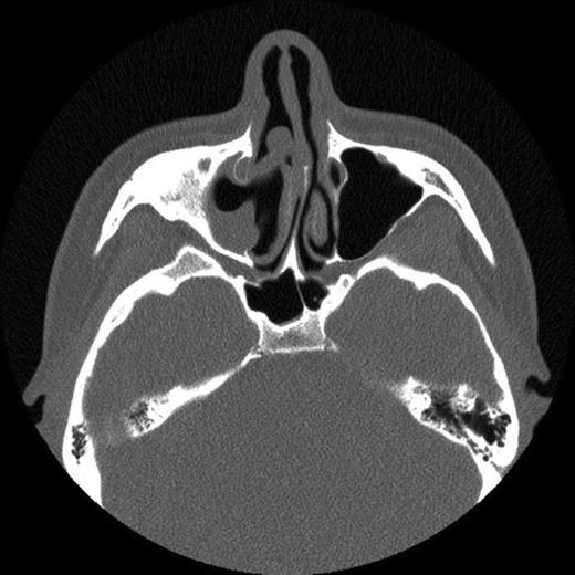 CT scan showing extensive polyp mass in right maxillary sinus with extension into right nasal cavity