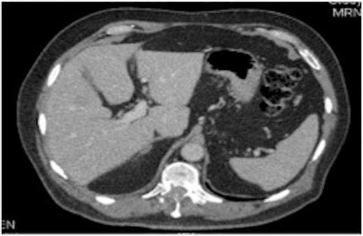 Original thoracic CT scan, which was performed 2 months prior to the MRI, shows the spinal metastasis