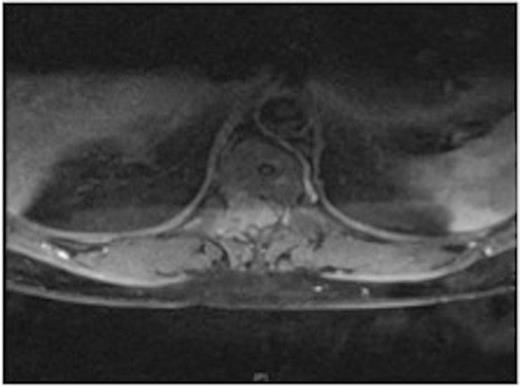 MRI showing the extra-dural tumour and extension into the soft tissue of the back
