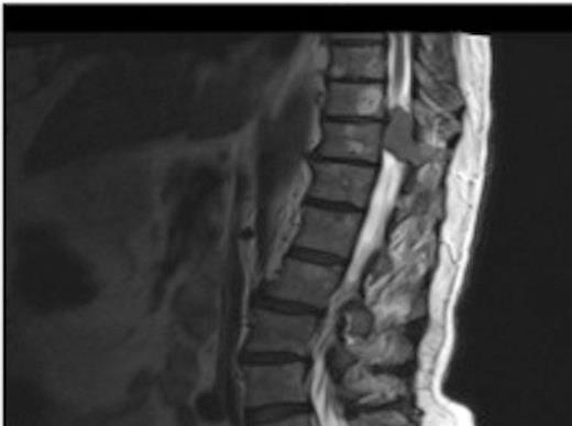 MRI showing the T10-11 extra-dural tumour with erosion of the T12 pedicle