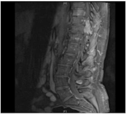 MRI showing the T10-11 extra-dural tumour with erosion of the T12 pedicle