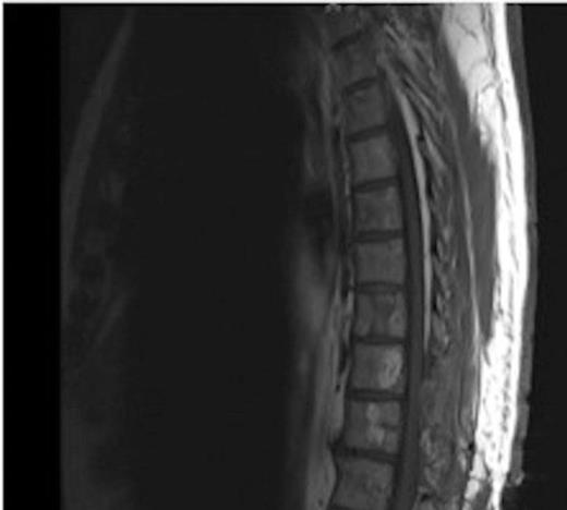 MRI showing the T10-11 extra-dural tumour with erosion of the T12 pedicle