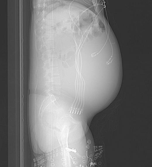 Lateral abdominal scout image for CT demonstrating significant abdominal distension
