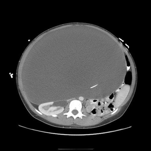 Abdominal CT, axial view, demonstrating a large fluid compartment surrounding the VP shunt catheter resulting in mass-effect, hydronephrosis, and displacement of the intra-abdominal contents