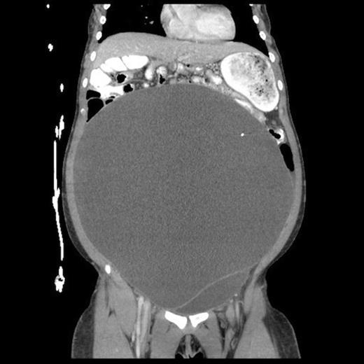 Abdominal CT, coronal view