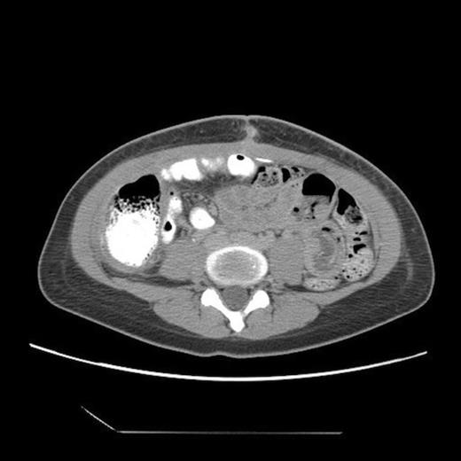 Post-operative abdominal CT demonstrating complete resolution of the fluid compartment
