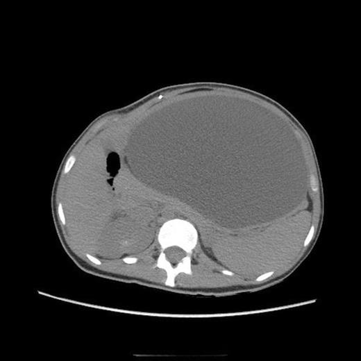 One-month follow up abdominal CT demonstrating recurrent formation of abdominal pseudocyst