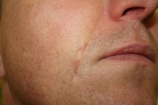 Post-operative scar