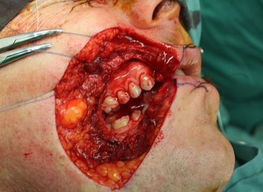 Patient underwent a full thickness re-excisionof residual right cheek DFSP