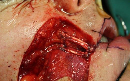 Two strips of palmaris longus tendon were used to re-suspend LAO and zygomaticus major