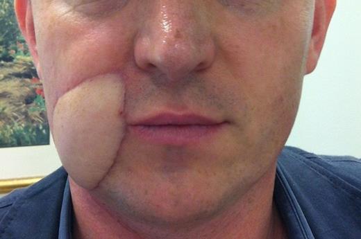 Post-operative appearance