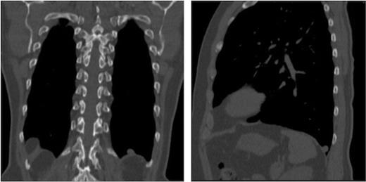Coronal CT image of the thorax demonstrating nodule 1 overlying the left hemidiaphragm. Sagittal CT image of the left hemithorax demonstrating nodule 1 overlying the left hemidiaphragm