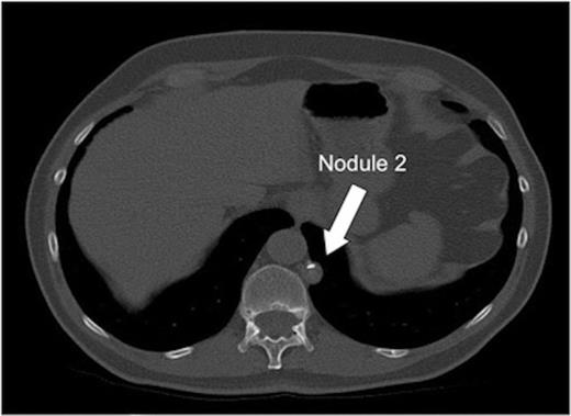 Transverse CT image of the thorax demonstrating nodule 2 adjacent to the mediastinum, vertebral body and descending aorta