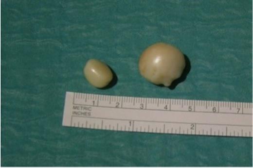 Both nodules after retrieval from the left hemithorax