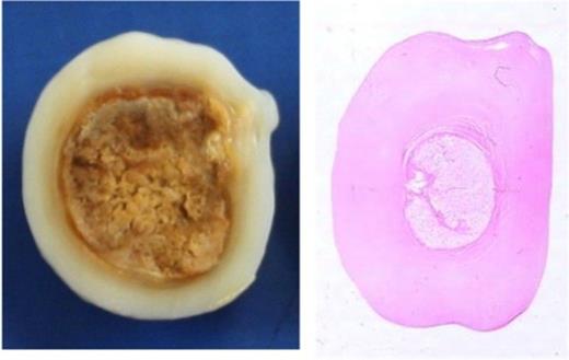 Cut section of the smaller nodule showing a thick, pale shell of tissue with appearances similar to cartilage. H&E stained whole-mount section (1x magnification) of the same slice of tissue