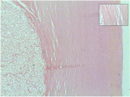 Thick shell of paucicellular collagen surrounding necrotic fat (40x magnification). Inset: Closer view of concentrically arranged thin layers of collagen