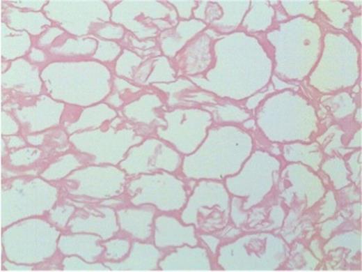 Necrotic adipose tissue centrally within the nodule (200x magnification)
