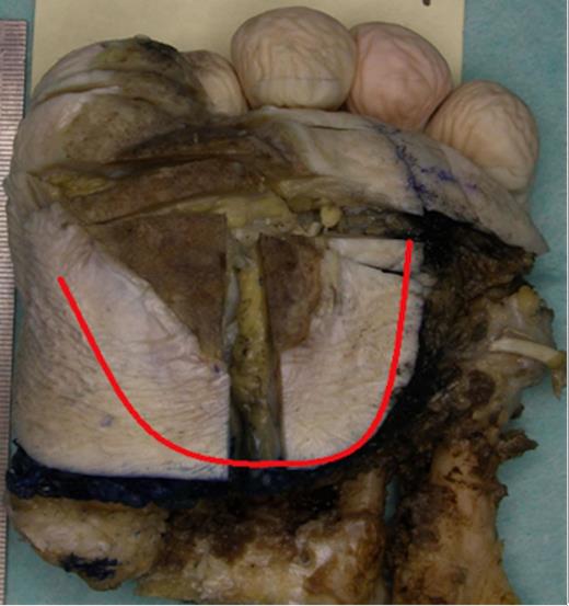 Plantar view of the left forefoot showing a large keratinising Squamous Cell Carcinoma over the medial aspect of the forefoot extending to the plantar aspect of the great toe, accompanied by extensive superficial invasion of the subcutis, extending 15mm radially from area of ulceration (red line)