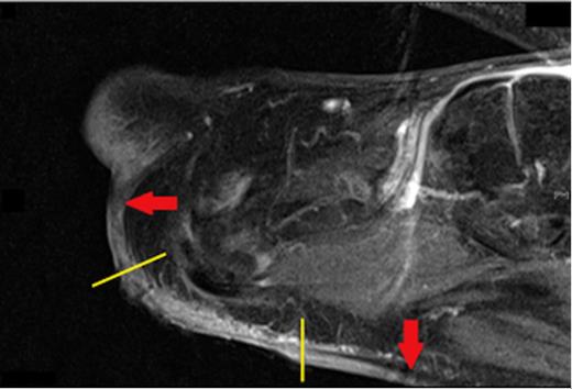 Sagittal view of a T1 weighted MRI showing the extent of subcutaneous spread of the Squamous Cell Carcinoma (red arrows) beyond the visible edges of the ulcer (yellow lines)