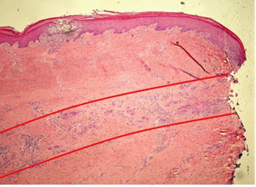 Histopathological slide of the indurated skin taken 10mm away from the ulcer showing a moderately differentiated Squamous Cell Carcinoma invading the deep dermis in a band like fashion, parallel to the epidermis (red lines). The local infiltration is well confined to the subcutaneous plane without peri-neural or deep structure involvement