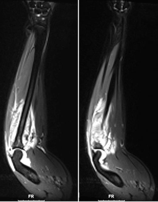MRI of the forearm (coronal sections) shows enhancement on T2-weighted images suggesting edema in the region of the ulna (left) and dorsal forearm musculature (right).
