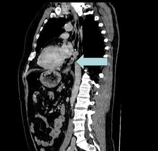 CT scan showing enlarged soft tissue deposits in a left paraoesophageal, pre-aortic site within the posterior inferior mediastinum