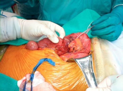 Intraoperative images of pancreas-sparing duodenectomy: Complete mobilization of duodenum and head of pancreas showing the tumour in the second/third portion of duodenum