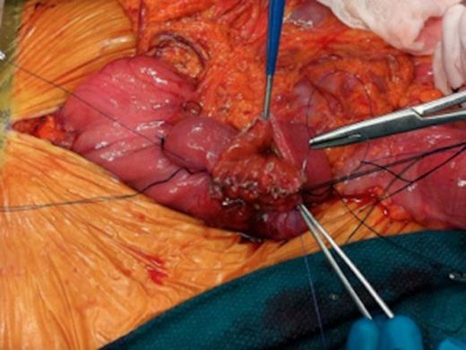 Intraoperative images of pancreas-sparing duodenectomy: Hand sewn, side to side, duodenojejunal anastomosis