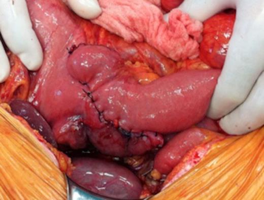 Intraoperative images of pancreas-sparing duodenectomy: completed anastomosis