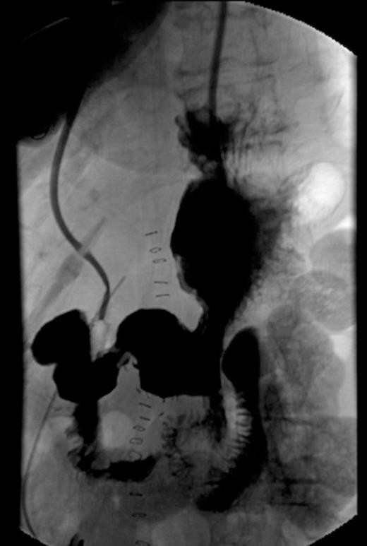 Post-operative UGI series showing no anastomotic leaks and patency of anastomosis.