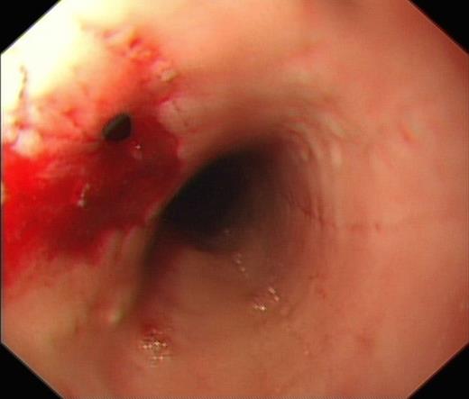 OGD showing perforation at 25cm from incisors