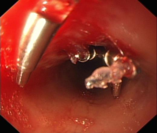 OGD showing clipped perforation at 25cm from incisors and further perforation at 27cm from incisors