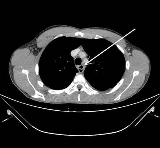 CT thorax showing pocket of air anterior to oesophagus (indicated by arrow)