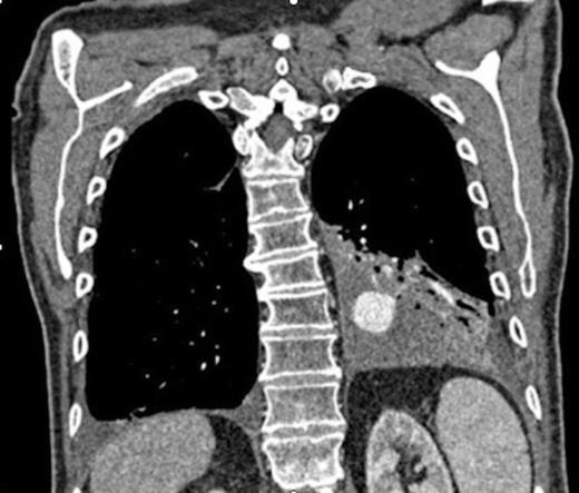 Coronal CT image in arterial phase demonstrating a 28mm diameter left lower lobe pulmonary artery aneurysm in association with a fluid collection
