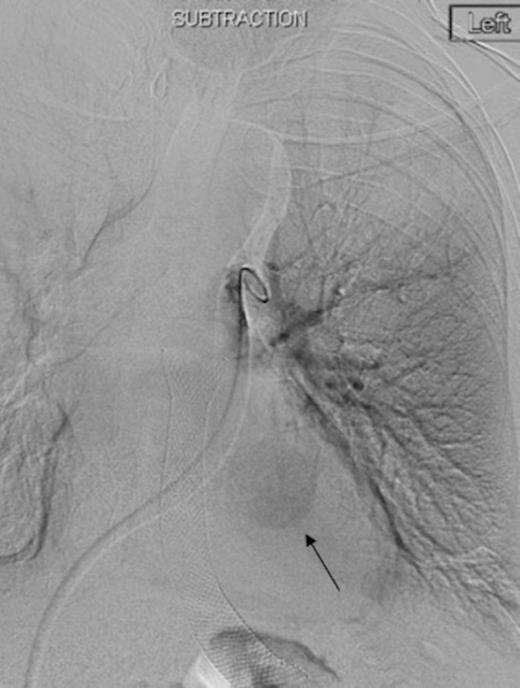 Left pulmonary artery digital subtraction angiography image demonstrating filling of left lower lobe aneurysm (arrow)