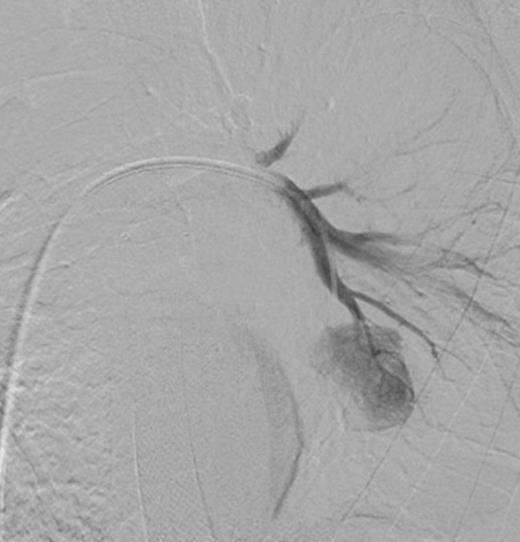 Selective digital subtraction angiography image of left lower lobe pulmonary artery, demonstrating filling of the inflammatory aneurysm and depicting the feeding branches clearly