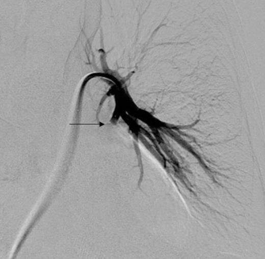 Digital subtraction angiography post deployment of the AVP 4 device in the PA branch feeding the aneurysm (arrow). No residual or collateral filling seen