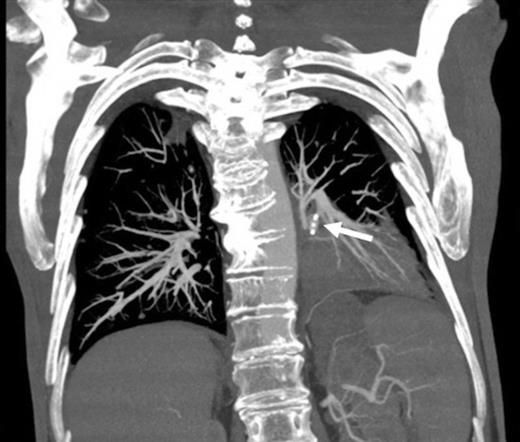 Coronal reconstruction of CTPA taken 2 days after embolisation demonstrating successful ongoing exclusion of the PA aneurysm. Note the AVP (arrow) and continued filling of unaffected lower lobe segmental pulmonary arterial branches