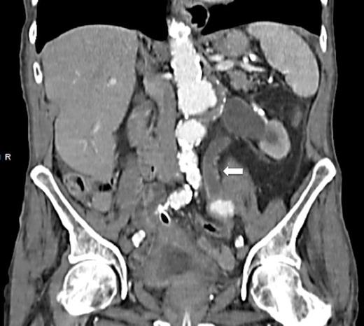 CT scan demonstrating hydronephrosis and hydroureter on the left side