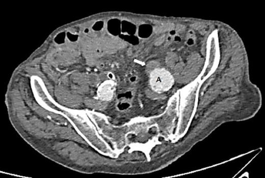 CT scan demonstrating hydronephrosis and hydroureter on the left side