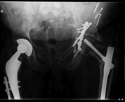 X-ray of the pelvis showing the wiring of the pubic symphysis, internal fixation of the left acetabulum and right total hip replacement