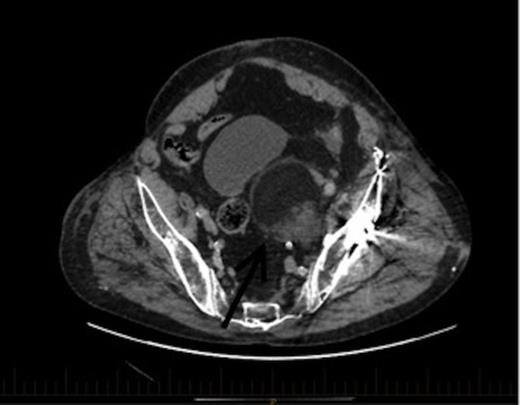 An axial section of the CT demonstrating a 6.7x6cm.3x7.3cm left pelvic lesion adjacent to the trauma site. Arrow denotes the EMH lesion