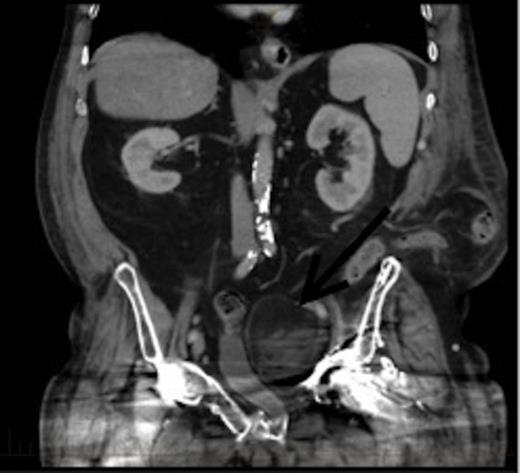 CT coronal view of the lesion demonstrating compression of the bladder. Arrow denotes the EMH lesion