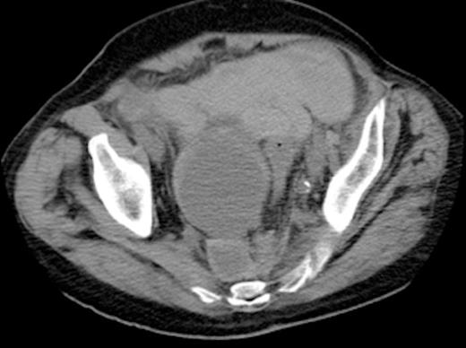 Axial view of CT abdomen-pelvis showing right internal iliac artery aneurysm with a contained pre-sacral leak (as indicated by arrow)